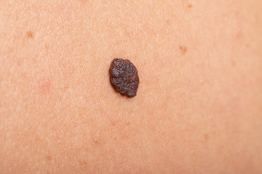 Safe and Easy Skin Tag Removal: From Home Remedies to Medical Solutions